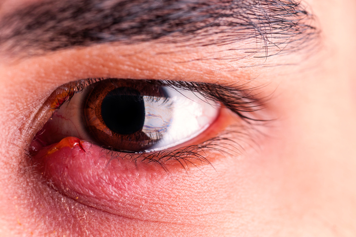 Augengrippe - sehr ansteckende Viruserkrankung der Augen.