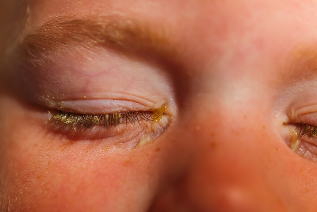 Augenentzündungen bei Kindern: Jucken, Rötungen und Tipps