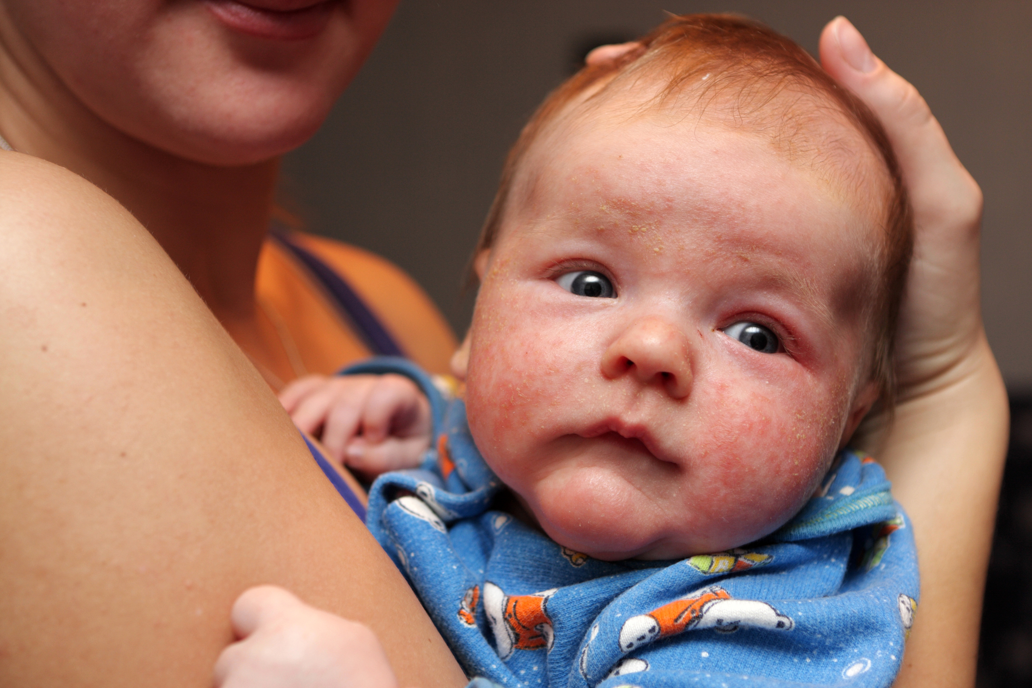 Dermatitis: Wie kann ich meinem Baby helfen, wenn die Haut juckt?