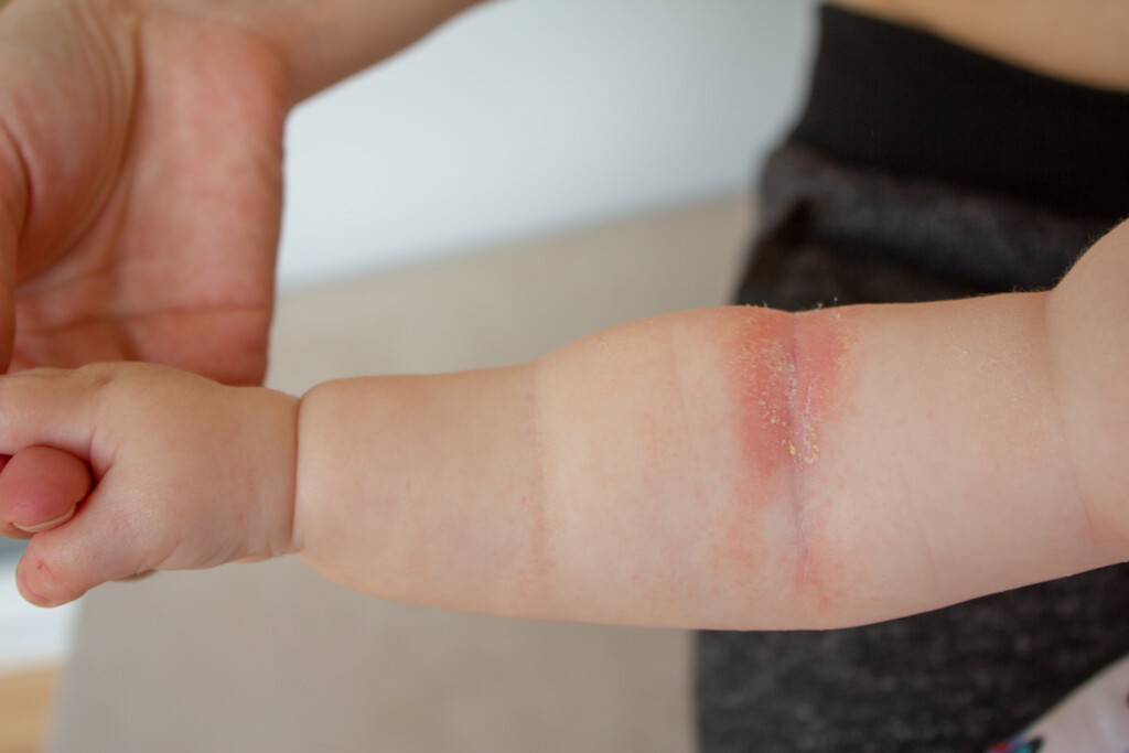 Kuhmilchallergie bei Säuglinge und Kinder